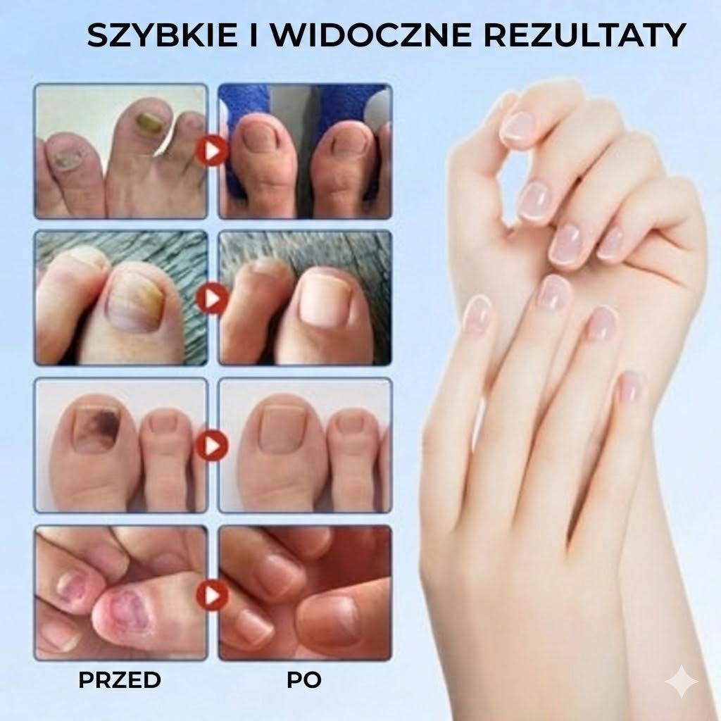 FungalPatch – Intensywny zestaw do pielęgnacji paznokci – Samoprzylepne plastry przeciwgrzybicze