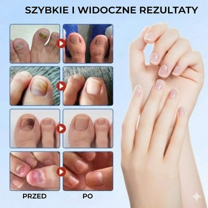 FungalPatch – Intensywny zestaw do pielęgnacji paznokci – Samoprzylepne plastry przeciwgrzybicze