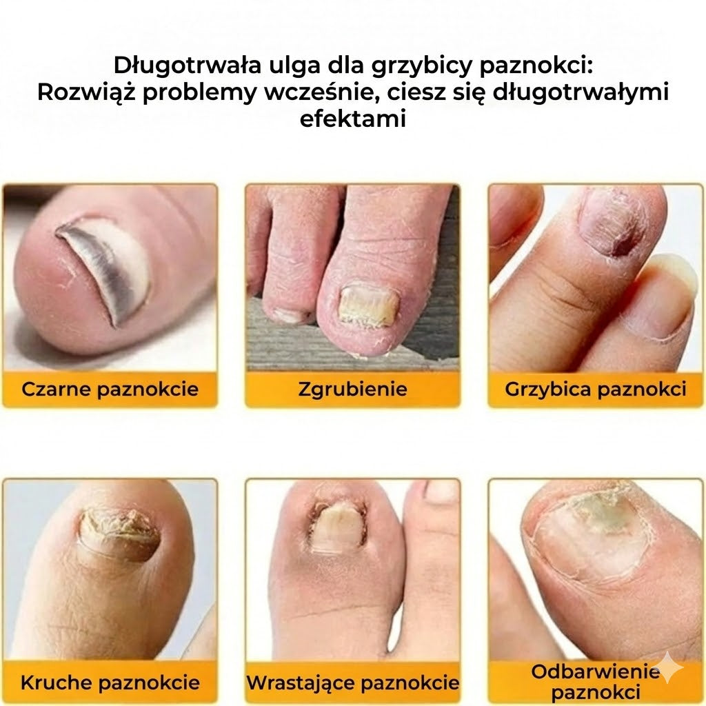 FungalPatch – Intensywny zestaw do pielęgnacji paznokci – Samoprzylepne plastry przeciwgrzybicze